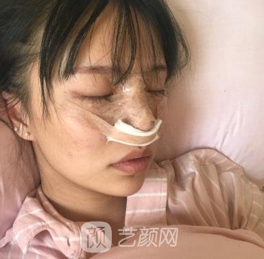 湘雅龙剑虹隆鼻实例，办公室C位女生就是我