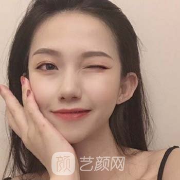 华美宋晓东隆鼻实例，真人修复全过程一览，差别很大