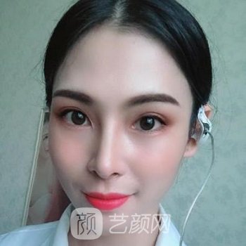 周栩隆鼻实例，术后美翻天，仿佛美少女一般