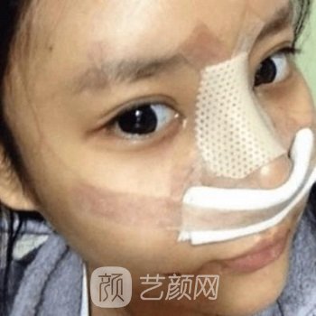 胡凯院长隆鼻实例，肋软骨隆鼻术后成为无死角美女