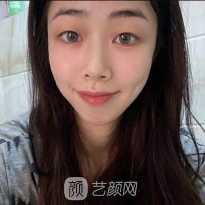 福州涣美整形医院隆鼻整形实例分享｜成果自然美观