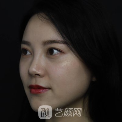 长沙华韩华美孙玥玥隆鼻技术怎么样？2022全新实例一览