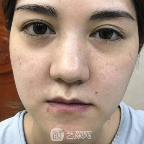 杭州美天美做超声刀美容怎么样？医院招牌实例发布