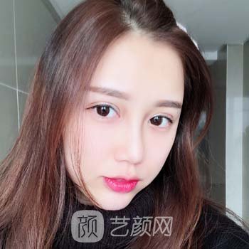 孙华凤隆鼻实例，术后咱也是个妥妥的大美女！