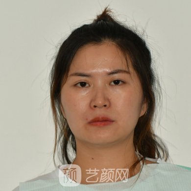 宁夏华美整形美容医院除皱怎么样?亲身体验实例展示