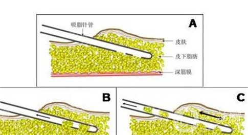 吸脂有害吗？如何保证吸脂的安好性？