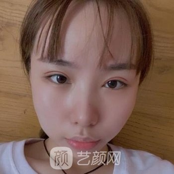 郑州孟明星给我做坏了眼睛？修复之后才知道有多美丽