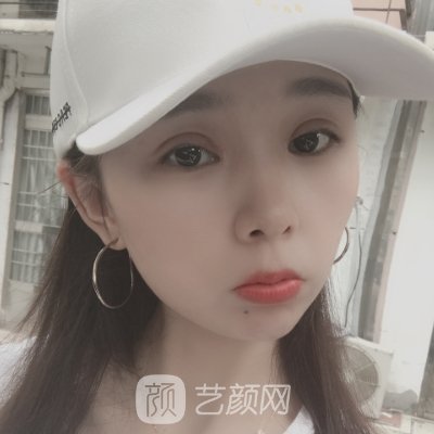 成都素美杨迪做双眼皮怎么样?2023新版实例出炉