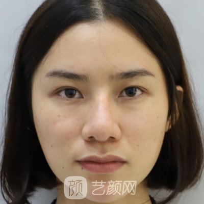 海南韩美医学美容医院隆鼻实例曝光|内附体验成果图