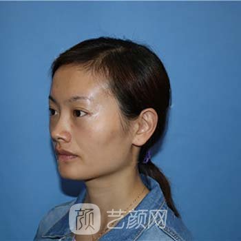 长春辰星医疗美容医院自体脂肪填充怎么样？附面部填充实例