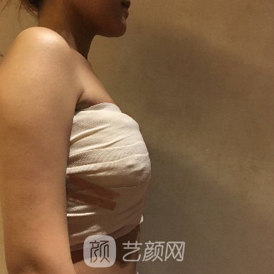 广州联合丽格美容医院隆胸成果怎么样?全新体验实例曝光