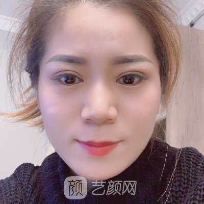 郑州缔莱美杨胜发做双眼皮怎么样?医生实力及实例曝光