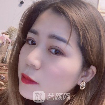 郑州缔莱美杨胜发做双眼皮怎么样?医生实力及实例曝光