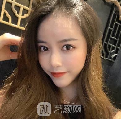 尚星医美张浩隆鼻手术实例，术后鼻子的形状我很满意，美丽加倍