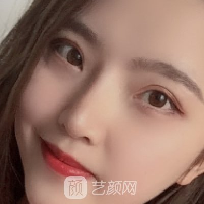 南宁美丽焦点是正规医院吗?医院全新隆鼻实例公开