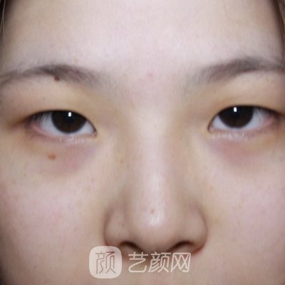 上海欧莱美医疗美容医院正规吗?2023全新双眼皮实例展示