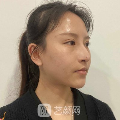 深圳美莱隆鼻怎么样?医院实力及实例出炉