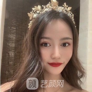 郑州美那多整形医院怎么样？医生简介+双眼皮实例