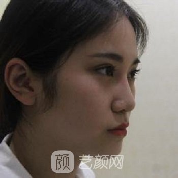 王本峰隆鼻实例，术后变得好漂亮，每天都美滋滋的~