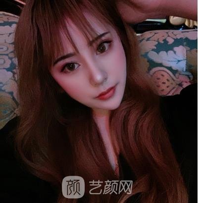 罗远亮隆鼻实例，让我变成了一个精致的小女生~