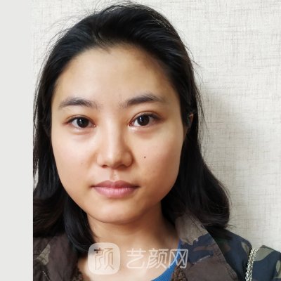 上海华美李健医生隆鼻风格公开|附体验成果图