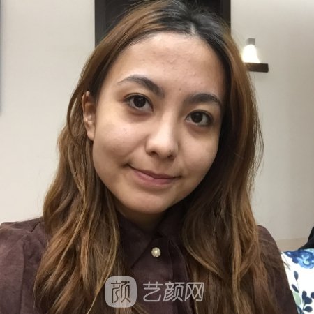 重庆美莱面部提升实例出炉|前后对比成果让人惊讶