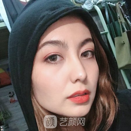 重庆美莱面部提升实例出炉|前后对比成果让人惊讶