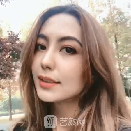 重庆美莱面部提升实例出炉|前后对比成果让人惊讶