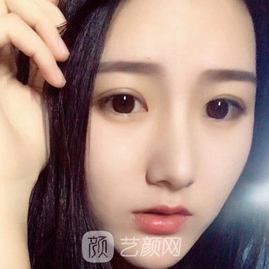 广州美恩整形医院做鼻子好吗?医院实力及实例曝光