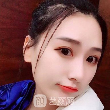 重庆天妃美容整形医院隆鼻咋样?2023实例发布