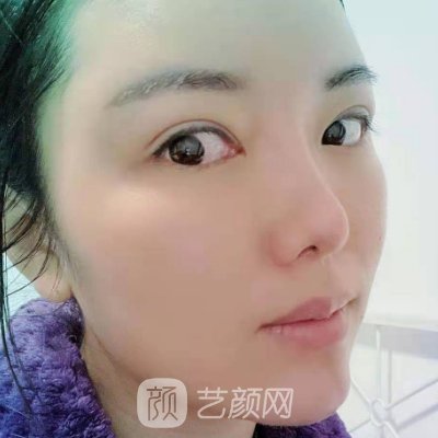 北京医院整形科玻尿酸面部填充实例公开｜成果自然美观