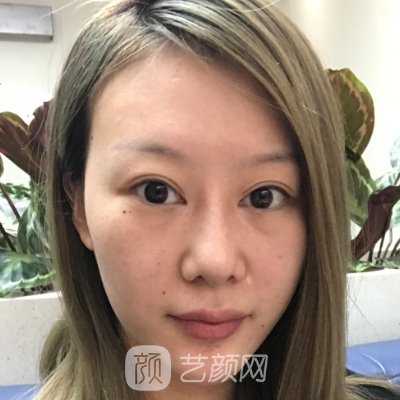 北京基础美医疗美容医院正规吗？全新面部提升实例发布