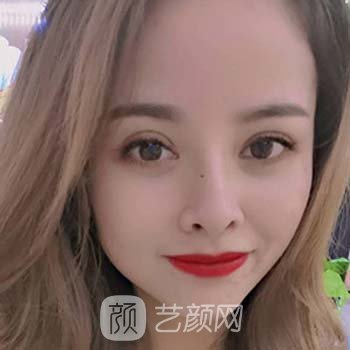 周兆平双眼皮实例，术后变成元气美女，眼眸超美~