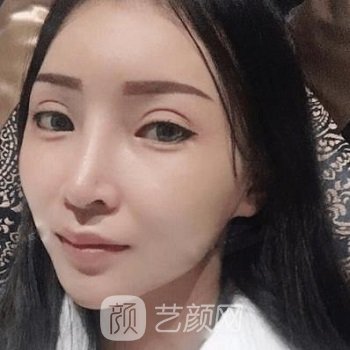 李炳浍隆鼻实例图片，术后让我拥有了这么美丽的鼻子~