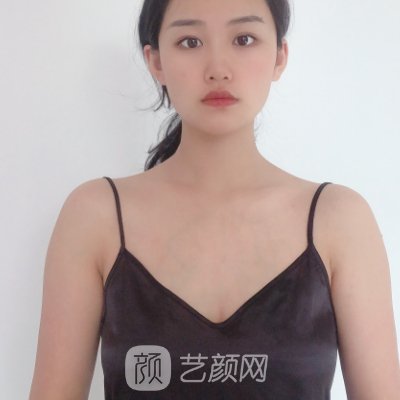 厦门中山医院张婧婧脂肪隆胸实例展示｜附体验成果图