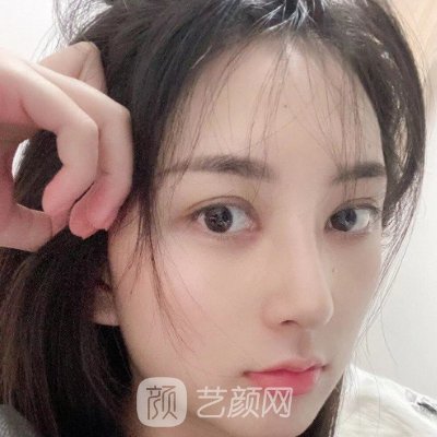 衡阳爱思特医疗美容医院口碑怎么样?全新隆鼻实例集中一览