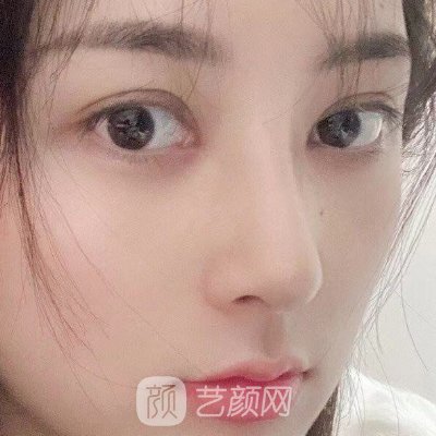 衡阳爱思特医疗美容医院口碑怎么样?全新隆鼻实例集中一览