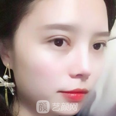 长春中研双眼皮成果图出炉｜成果自然美观