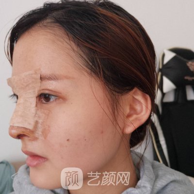 南昌同济整形医院高超做鼻子怎么样？亲身体验实例出炉