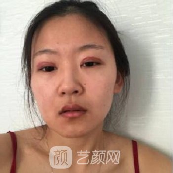 承德附属医院美容科怎么样？能做双眼皮吗？实例+价格表