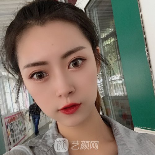 深圳市人民医院整形外科面部脂肪填充实例公开|美观又自然