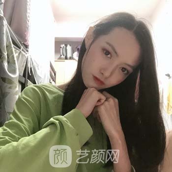 西安黄凯隆鼻实例图片，术后随便画个淡妆看着鼻子也很立体