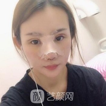 董佳生隆鼻实例，术后鼻子精致又美观，超自信