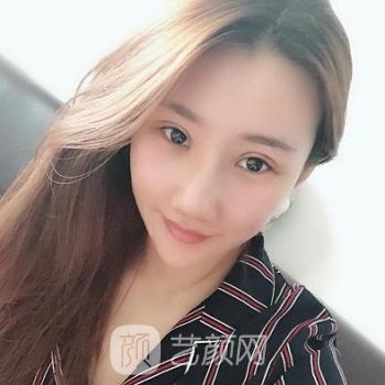 董佳生隆鼻实例，术后鼻子精致又美观，超自信