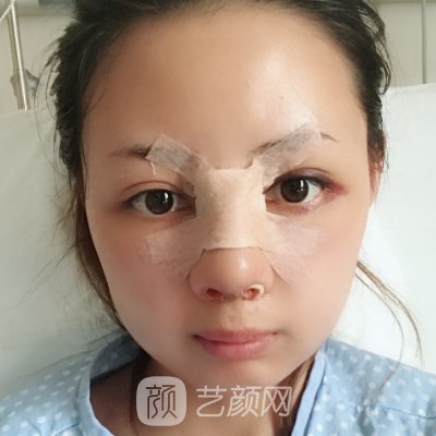 广州丽港丽格怎么样?医院实力以及隆鼻体验实例分享