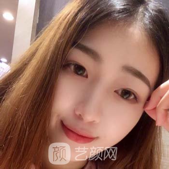 成都奕后刘俊隆鼻实例，术后鼻子特别的精致漂亮