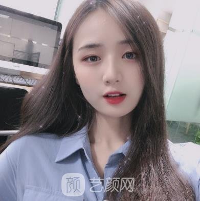 杨君毅磨骨实例，术后60天成为了别人羡慕的样子