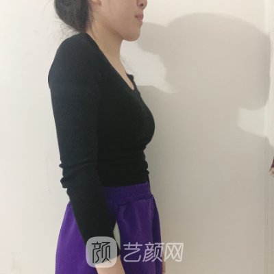 北医三院整形科吸脂整形实例发布|附体验感悟