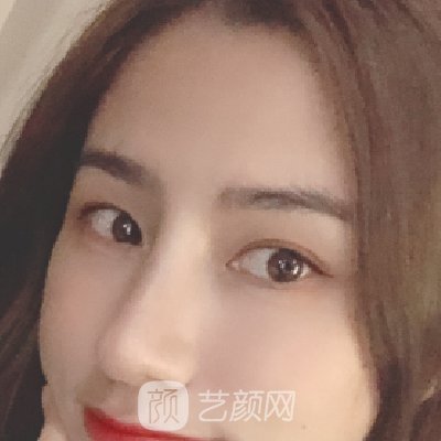 北京炫美是正规医院吗?隆鼻成果图出炉|成果自然美观