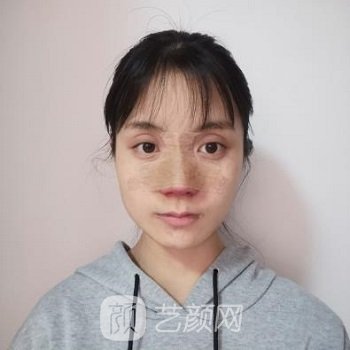 北京李海兵隆鼻实例，精致立体的小鼻子让我的颜值都有了提升